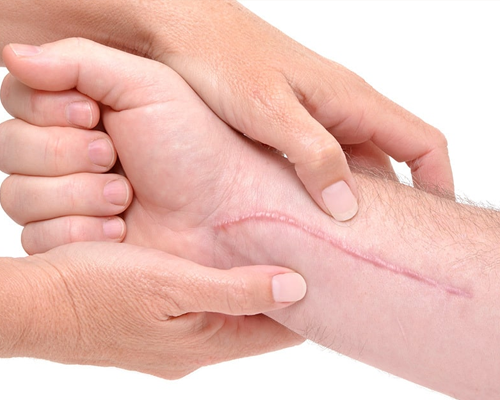 Scar Management