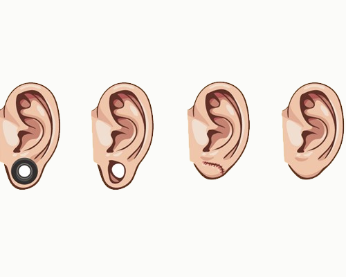 Ear Lobule Repair