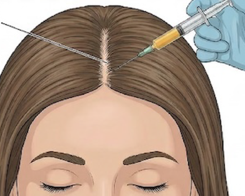 PRP/GFC for Hair Restoration