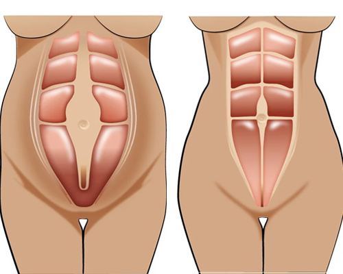 Abdominoplasty