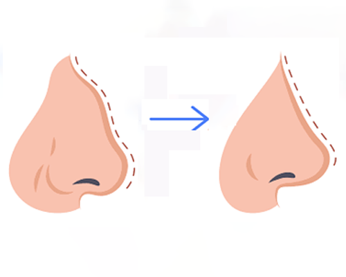 Rhinoplasty