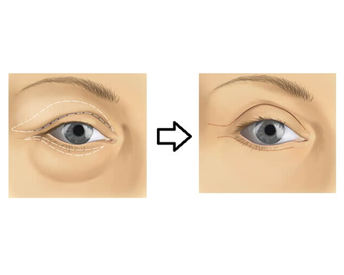 Blepharoplasty