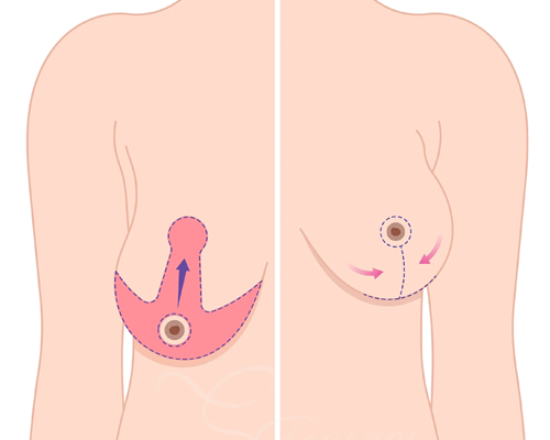 Breast Lift Reduction